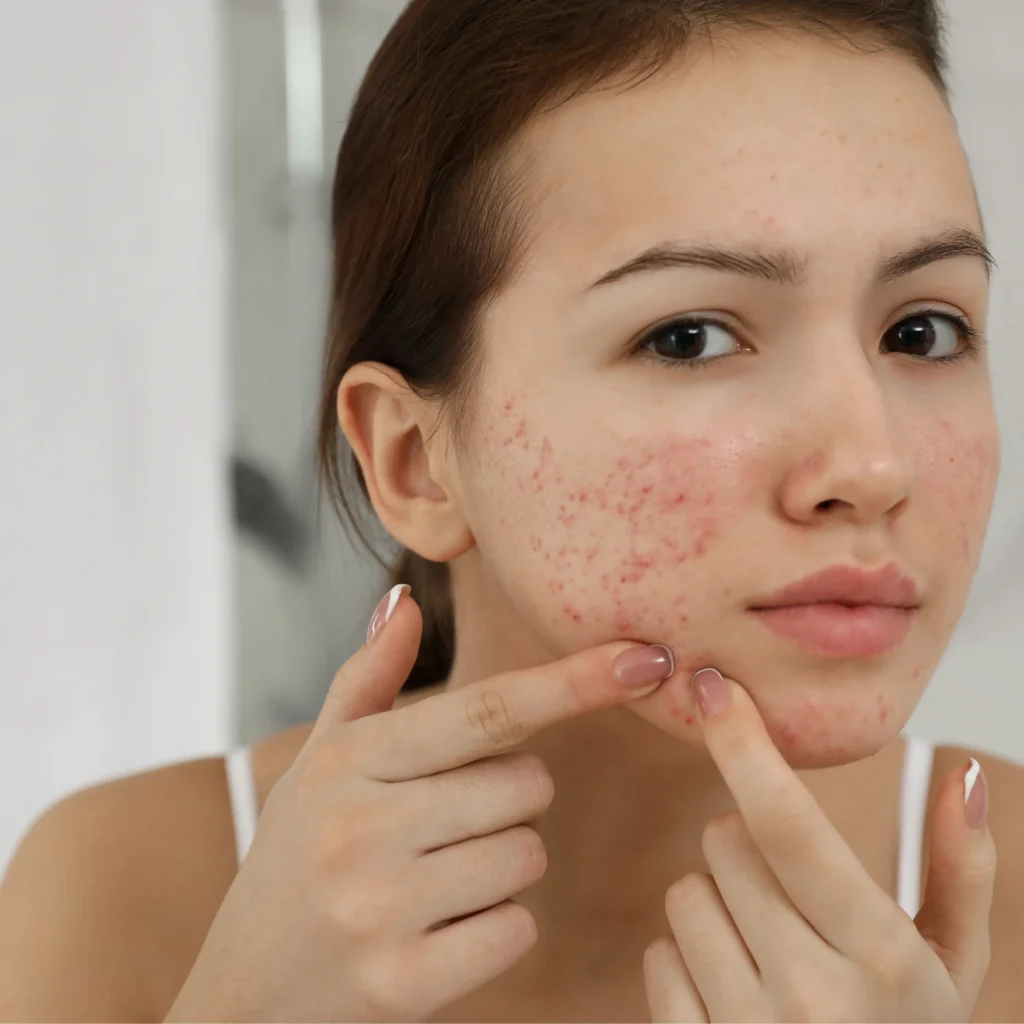 Acne-prone skin